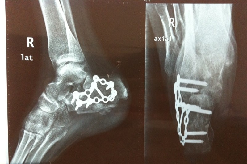  右脚跖骨骨折多久恢复;右脚跖骨骨折多久恢复正常